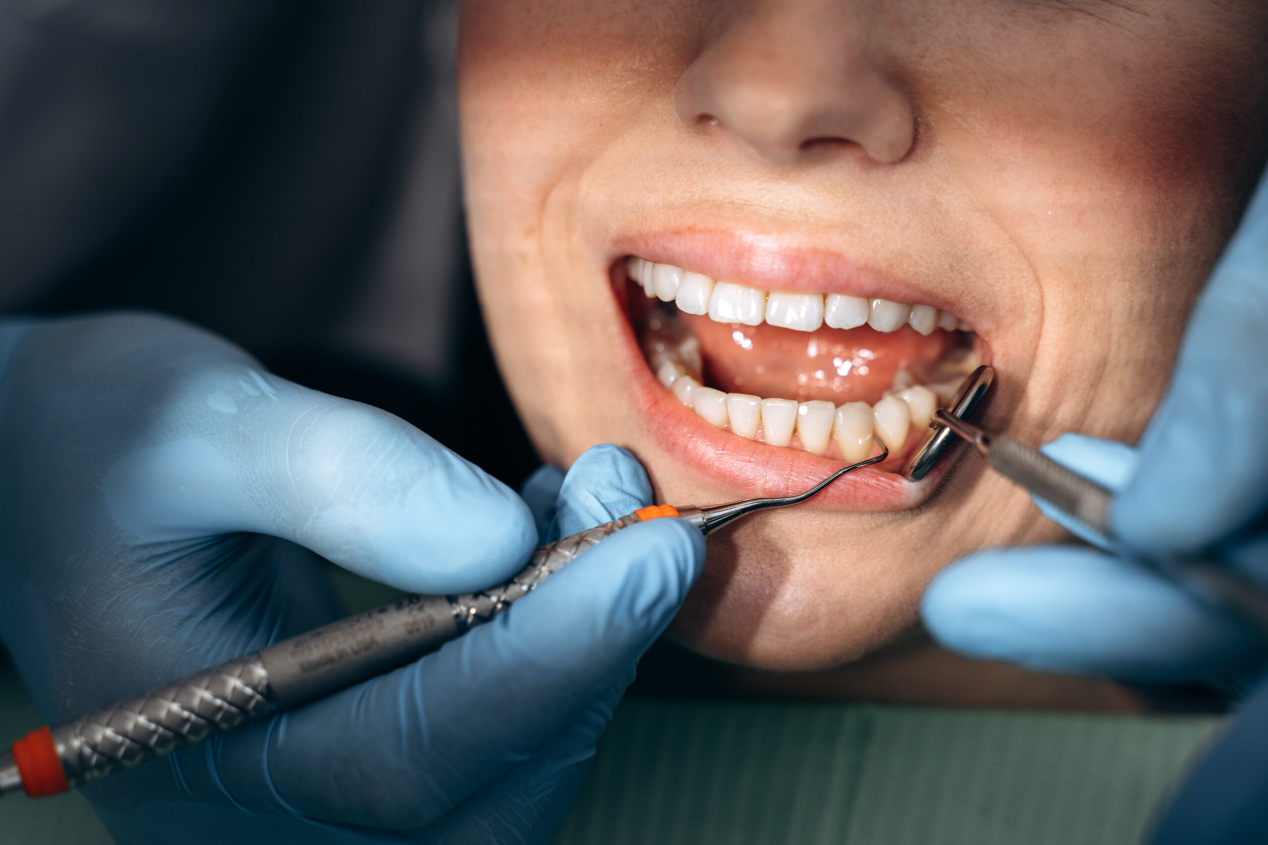 Close-up view, a doctor treats a person’s teeth. The dentist examines the patient’s teeth with the help of working tools what-to-expect-during-professional-dental-cleaning-in-roswell-nm