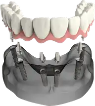 fuul-fixed-teeth-img
