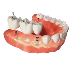 missing-teeth-img