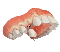 missing-tooth-img