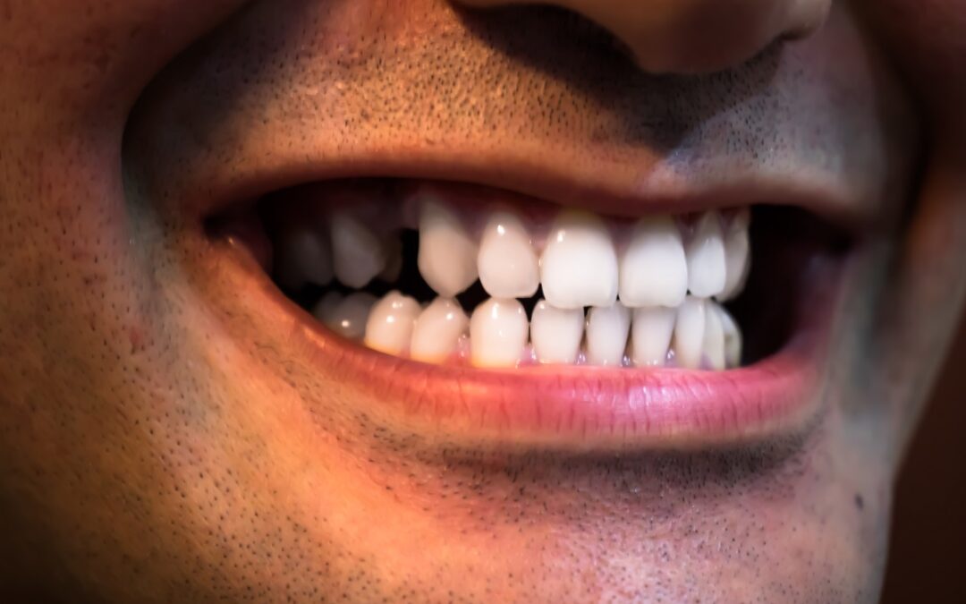 Lost a Tooth? Why Dental Implants Are the Leading Replacement Option