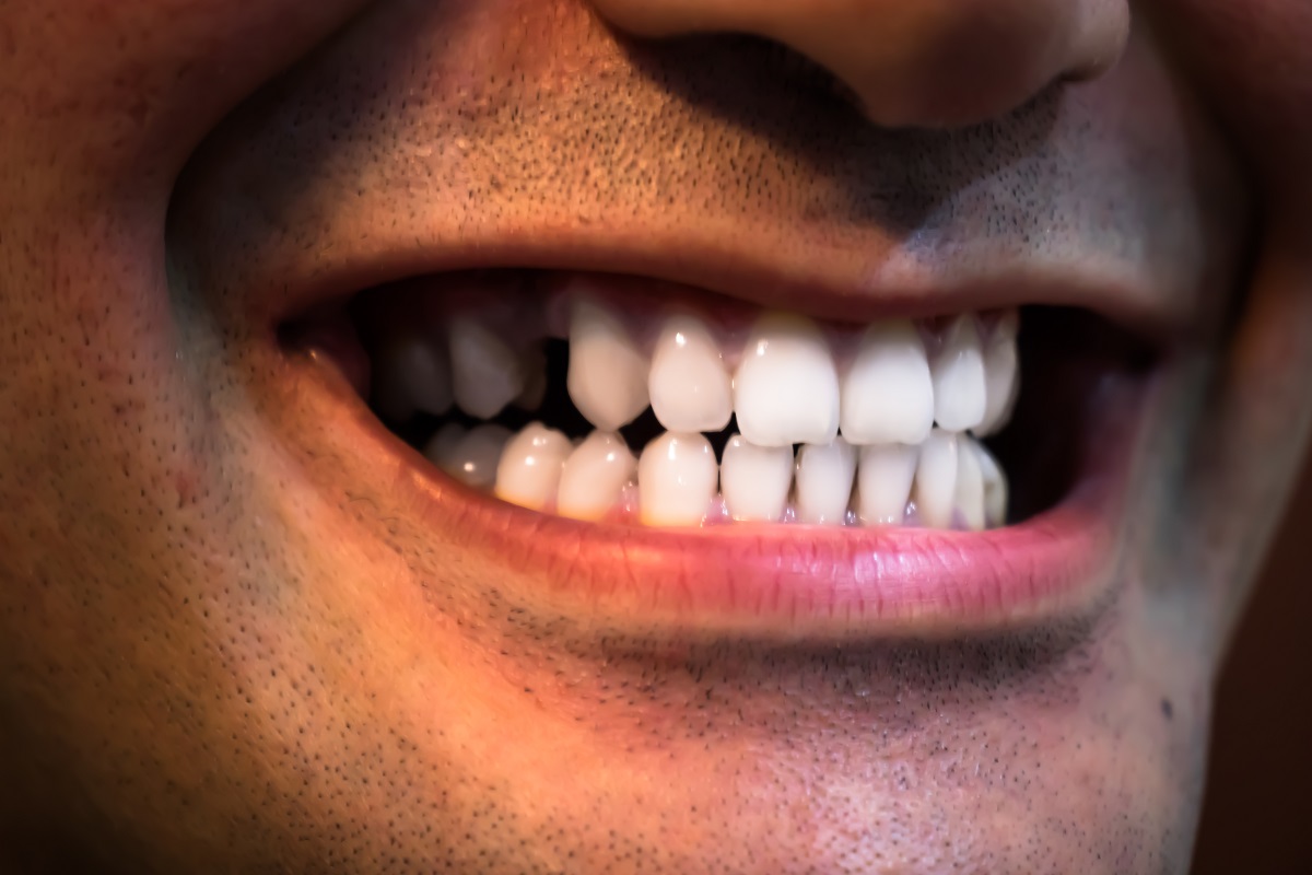 missing tooth solutions by dental implants near me in roswell